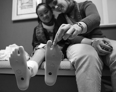 Limb loss can happen to young children as well as adults